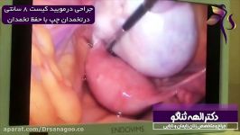 جراحی لاپاراسکوپی درمویید بزرگ ۸ سانتی حفظ تخمدان ها