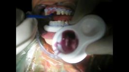 بلیچینگ یا سفید کردن دندان ها بخش 2