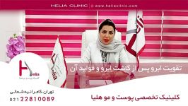 تقویت ابرو پس کاشت ابرو فواید آن  کلینیک هلیا  02122810089