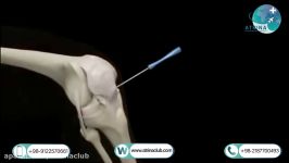 knee arthroscopy