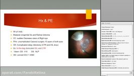 Case Presentation IOL and CTR drop