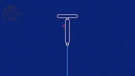 IUD نحوه عملکرد آن