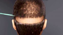 Hair transplant