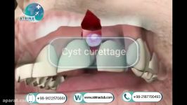 cyst curettage in atrina