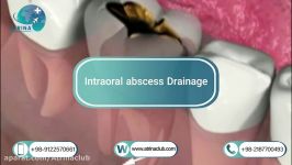 Intraoral abscess Drainage in atrina