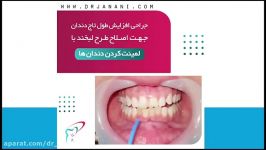 جراحی افزایش طول تاج دندان