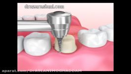 فیلم بازسازی کامل تاج دندان جایگزین روکش دندان ها