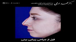 رضایت بیمار جراحی بینی  دکتر محمد ارمی