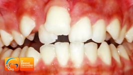 قبل بعد ارتودنسی بدون کشیدن دندان دکتر مسعود داودیان