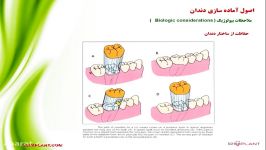 نکاتی مهم در تراش دندان‌ها برای روکش دکتر طباخیان