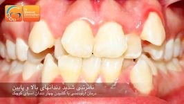 قبل بعد ارتودنسی کشیدن دندان  دکتر مسعود داودیان