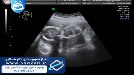 سونوگرافی آنومالی جنین هفته 18 مرکز تصویربرداری دکتر شاکری