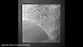 Ostial RCA CTO in a Stent Graft