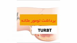 برداشت تومور مثانه TURBT  دکتر سید امین میر صادقی