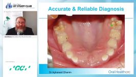 Hypermineralised enamel  MIH