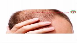 درمان قطعی ریزش مو رشد مجدد موی طبیعی
