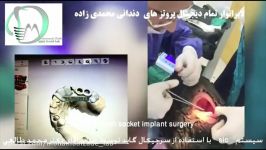 با استفاده سرجیکال گایدsic flapless fresh socket implant surgeryسیستم