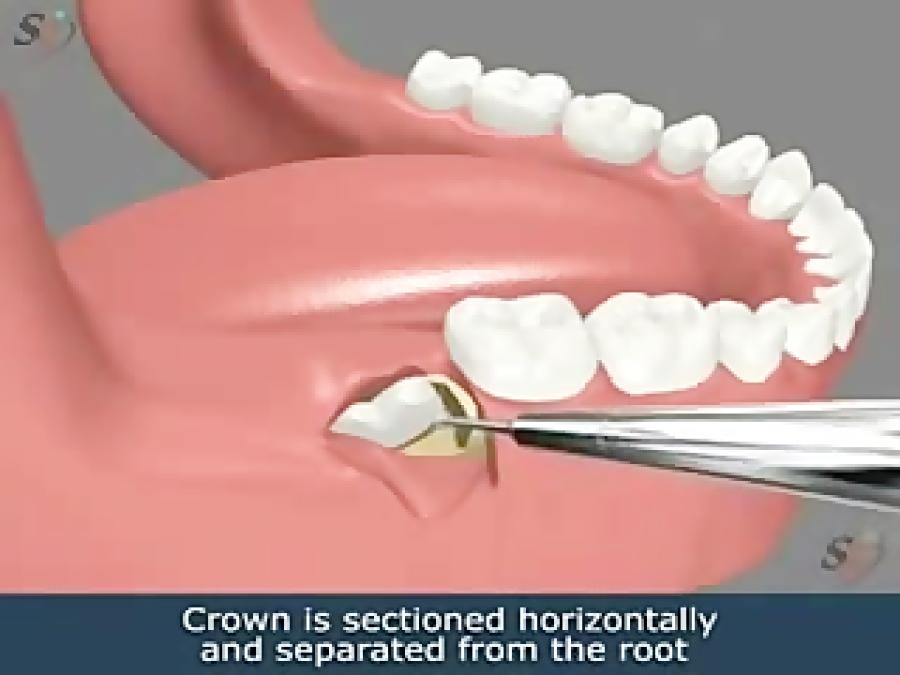 انیمیشن جراحی دندان عقل نهفته فک پایین