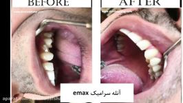 عکس های قبل بعد کامپوزیت ایمپلنت دندان