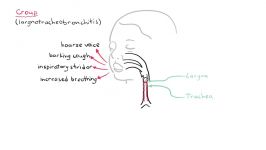 لارنگوتراکئوبرونشیت خروسک یا کروپ