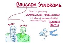 سندروم بروگادا brugada syndrome