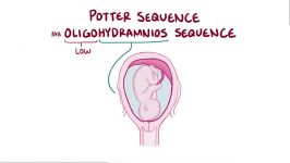 سندرم پاتر potter syndrome