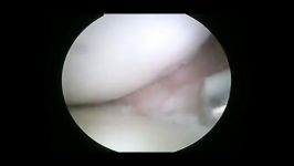 ACL Reconstruction Surgery