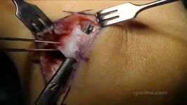 Knee Surgery Physeal Sparing ACL Reconstruction in the