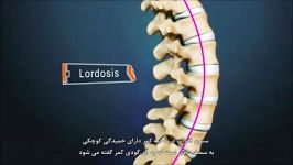 انواع درد ناحیه کمری ستون فقرات