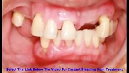 Bleeding Gums Treatment Breakthrough