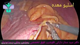 عمل جراحی اسلیو معده توسط دکتر سید ستار دارابی فلوشیپ فوق تخصصی جراحی چاقی