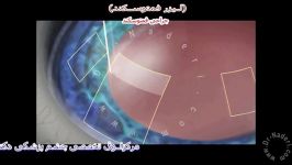 لیزر فمتوسکند  مرکز چشم پزشکی دکتر علیرضا نادری