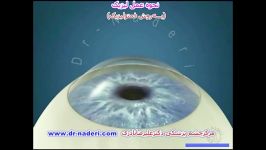 فمتولیزیک  مرکز چشم پزشکی دکتر علیرضا نادری