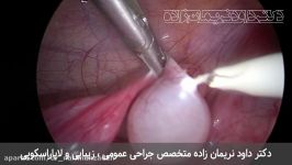 فیلم عمل جراحی لاپاراسکوپی کیست لوله فالوپ یا تخمدان توسط دکتر داود نریمان زاده