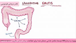 کولیت روده درمان قطعی آن