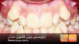 ارتودنسی نامرتبی شدید بدون کشیدن دندان  دکتر داودیان