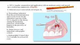 Angelus MTA سمان ترمیم ریشه زمان سخت شدن 15 دقیقه