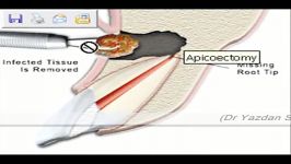 7 جراحی انتهای ریشه دندان