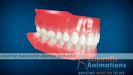 3 علت پوسیدگی دندان محلهای شایع پوسیدگی