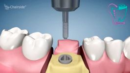 درمان ایمپلنت یک مرحله ای  سیمادنت
