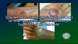 Skin cancer types treatment melanoma basal cell carcin