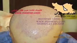 کاشت مو به روش fit در کلینیک دکتر رضائی