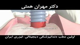 ُStraumann ITI Dental Implants