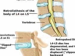 دررفتگی یا لقی مهره کمر چیست؟