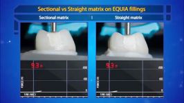 GC EQUIA Forteنسل جدید گلاس آینومر ترمیمی برای همه سنین