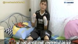 كودك سوریه ای چهره ای معصومانه كه ناحیه دو دست آسیب دیده است