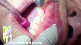 تراش پوسیدگی مجاور ریشه در دندانهای قدامی ترمیم