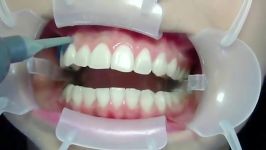 Angelus Clariant Dental Bleaching کیت بلیچینگ