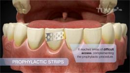 Prophylactic Strips  TDV