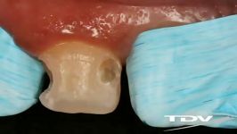 Restoration In Class III With TDV Products